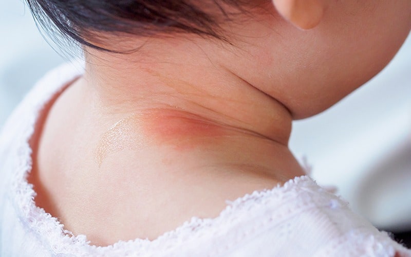 bebeklerde gıda alerjisi, hassasiyetleri ve egzama 
